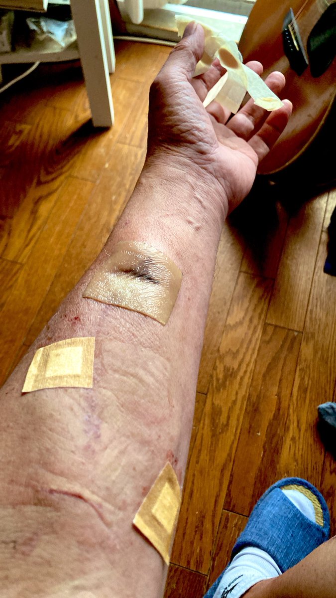 kaz6thlife's tweet photo. ãMy #dialysis #simptom's memoã
ð¥ðð©ââïžð©žðð©»â¿ïžðªð¥Œð¡ïž
å
#shunt éšã® #人å£è¡ç®¡ ãªãè·¡ã®æ²»ããé
ããçã¿ããããããð
ðžãäžæ²ã匟ããŸããããªãããªäžã§ããð§ https://t.co/AHsju5c2aL