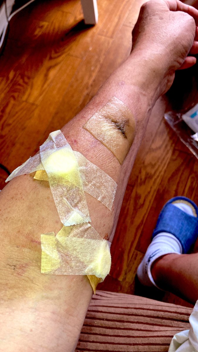 kaz6thlife's tweet photo. ãMy #dialysis #simptom's memoã
ð¥ðð©ââïžð©žðð©»â¿ïžðªð¥Œð¡ïž
å
#shunt éšã® #人å£è¡ç®¡ ãªãè·¡ã®æ²»ããé
ããçã¿ããããããð
ðžãäžæ²ã匟ããŸããããªãããªäžã§ããð§ https://t.co/AHsju5c2aL