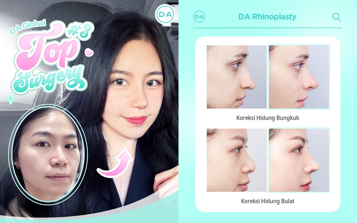 daprs_indo's tweet photo. 💕[Rhinoplasty DA]💕

Dapatkan wajah cantik dengan hasil yang memukau di DA!

karena cantik itu DA! 🥰 https://t.co/o8OkHIqY8F