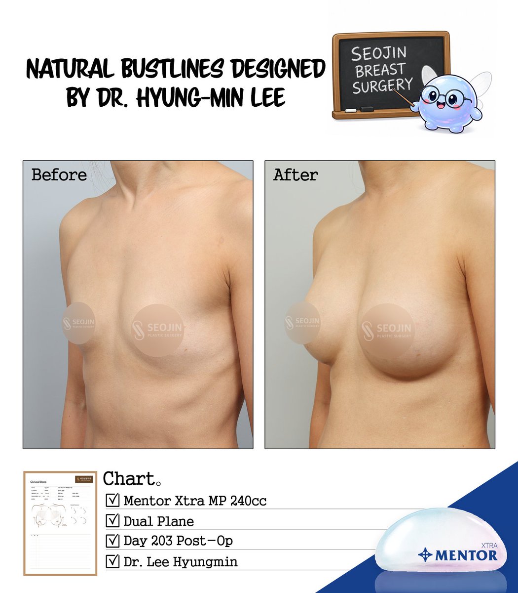 seojinps_eng's tweet photo. There’s a reason people call our results "effortlessly natural."
Dr. Hyung-Min Lee doesn't just focus on size, he designs natural bustlines with movement, contour, and overall silhouette in mind.
#BreastAugmentation #MentorXtra #KoreanClinic #DualPlane #BoobJob #BodyLine #Seoul https://t.co/6QtZqPxZlb