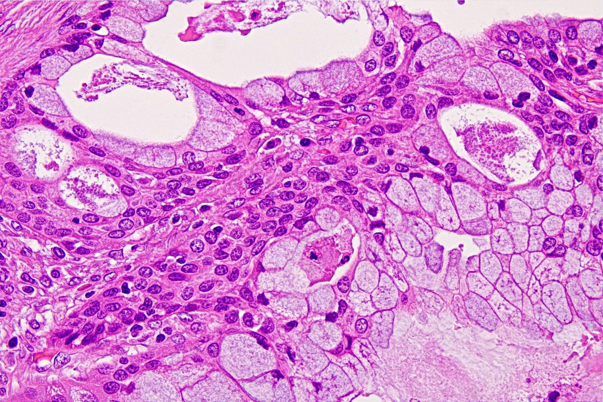 Patholwalker's tweet photo. Mucoepidermoid carcinoma of parotid gland. #Pathology #Pathologist #ENTPath https://t.co/VcxaTRGwBS