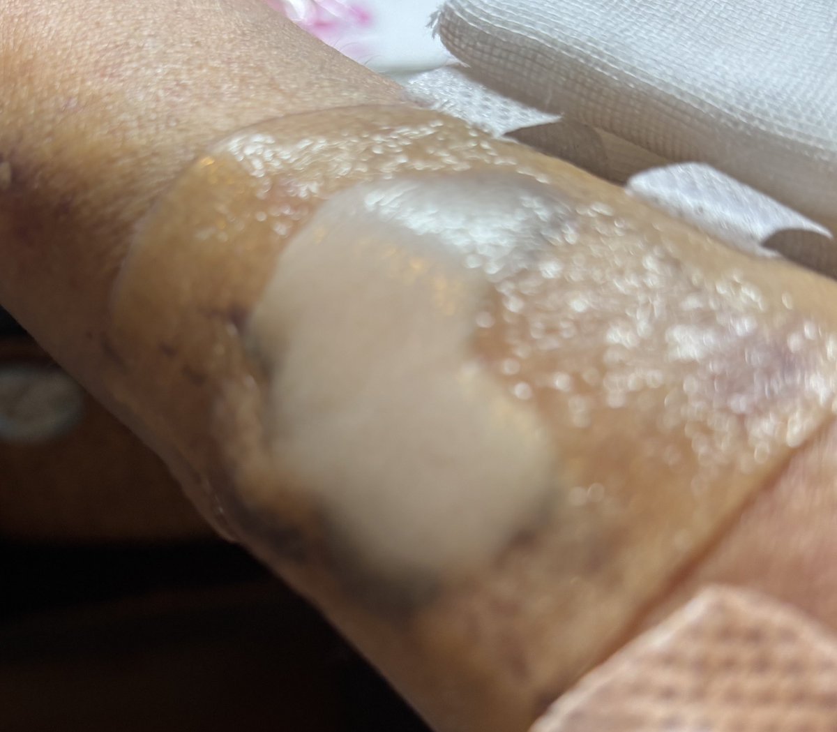 0131akitto's tweet photo. 昨日治療の為の麻酔テープを剥がす時に皮膚が一緒に剥がれて、皮膚の下のお肉が丸出しになりずっと出血してるので止血するまでの応急処置だけして今日改めて皮膚科へ行ってきたけど止血出来るまでは特殊なシールを交換していくらしいです。
とにかくずっと痛いのが嫌だよ😢 https://t.co/xLhbe07KKl