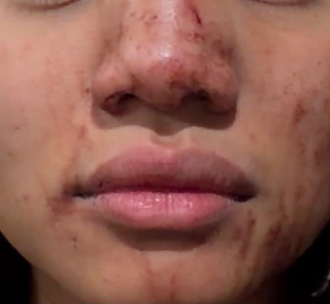 recehsjaa's tweet photo. BANTU UPPP

teman saya menjadi korban penganiayaan oleh SEORANG DOKTER SPESIALIS KANDUNGAN. teman saya sampai mengalami patah tulang di hidung dan memar parah di beberapa bagian tubuh! SEKALI LAGI SEORANG DOKTER BISA MELAKUKAN HAL SEPERTI ITU?

Laki2 ini seorang dokter spesialis kandungan berinisial L yang aktif praktik di rumah sakit terkenal di Bekasi Barat dan rumah sakit milik Pemerintah di Jakarta Utara.

Laki-laki ini merasa aman karena dia punya kaka laki2 yang bekerja sebagai polisi.

cc:jellyfish.45719234