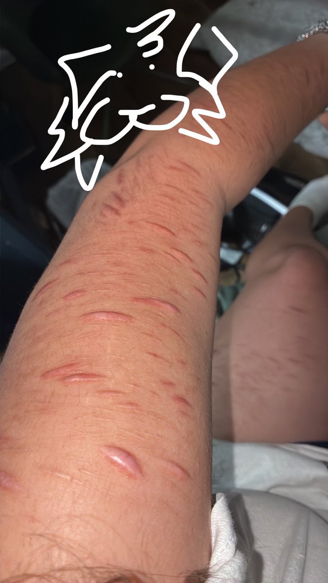 Salmongutz's tweet photo. twt took down my arm scars so i had to put content label on this one 🙁
anyways i love mu raised scars 🫦 https://t.co/azwjicyRXP