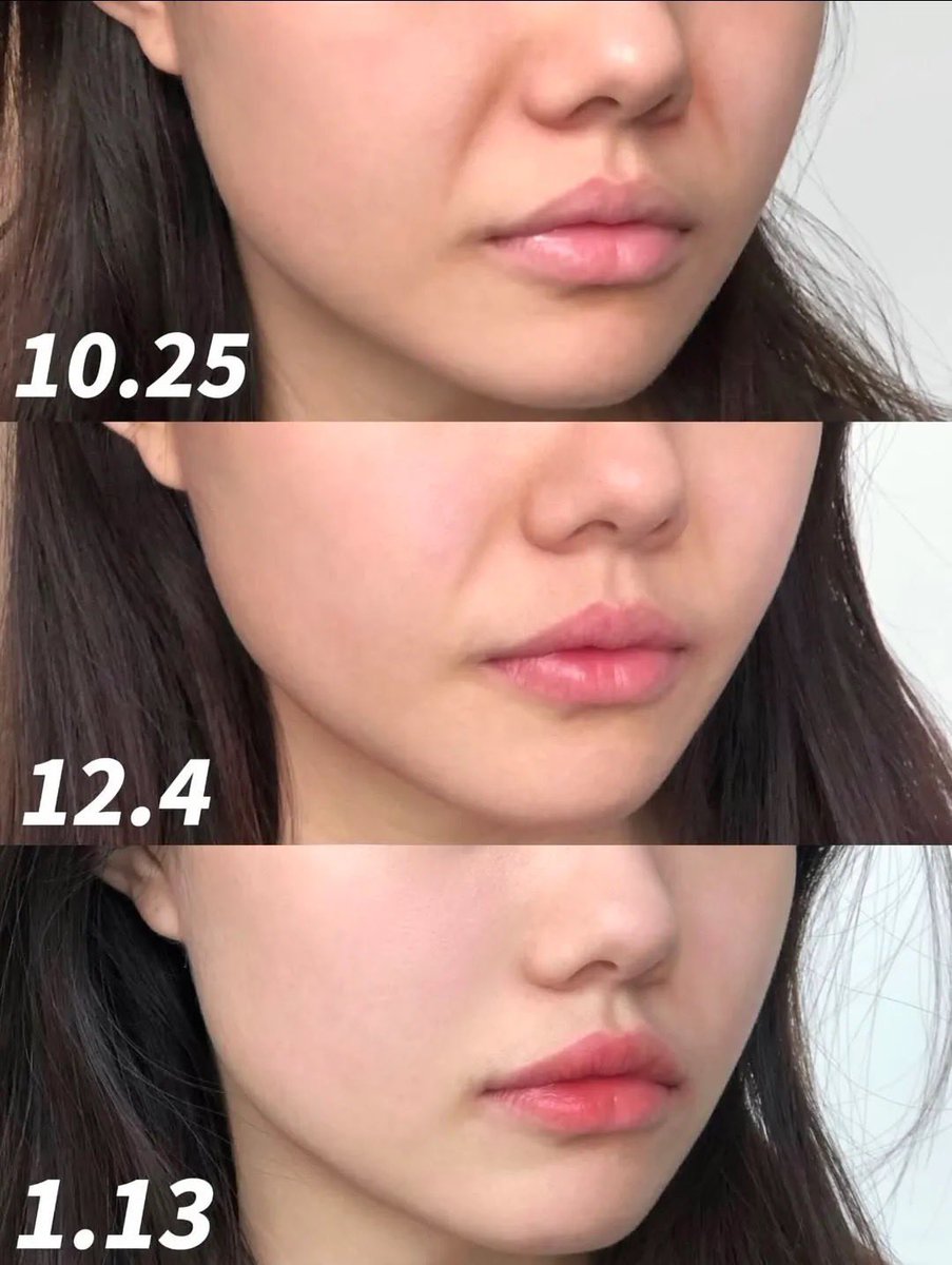 nadaeladela's tweet photo. Ternyata guasha aku dari dulu salah cara… pantesan hasilnya biasa aja 😭

Coba teknik yang bener langsung kerasa banget: blood flow lebih lancar, muka lebih ‘plump’, rahang jadi lebih kebentuk. 
Ternyata bukan asal usap… tapi ada urutannya, tekanan, sama arah tarikannya!￼ https://t.co/H3ATeYMlSq