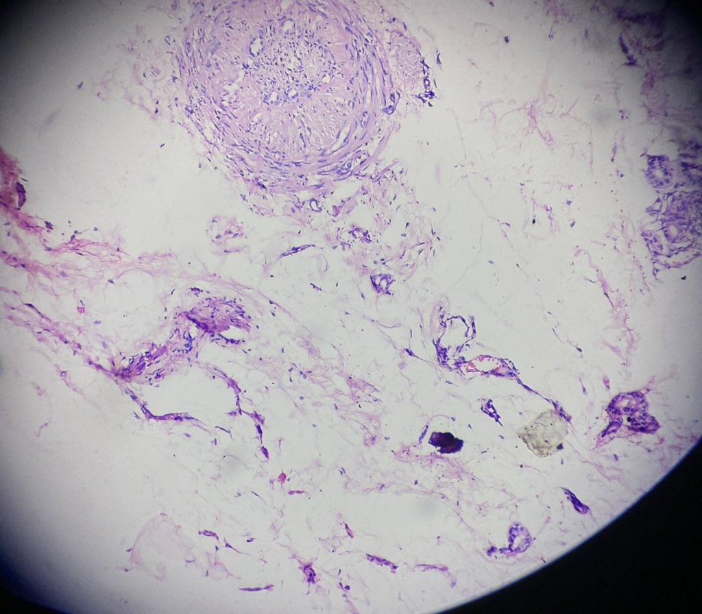 Simrangil128's tweet photo. 40/female Right hand gangrene , history of cold , no pulse felt ; b/l upper limb gangrene https://t.co/5C4lazBWdI