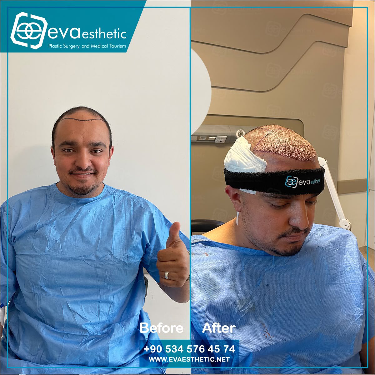 evaesthetic's tweet photo. Eva Esthetic | #Hair_Transplant ✔️.

#Hairtransplantation in #Turkey #Istanbul
Eva esthetic The #bestHairTransplant Hospital In #Istanbul 🇹🇷
#HairTransplantturkey
#plasticsurgery 
#Eyebrow_Transplant #Beard_Transplant
 🔗👇
Book now via📲:WhatsApp;📲 +905345764574
🇺🇸🇬🇧🇪🇸🇫🇷🇷🇴 https://t.co/oJNw68nbDE