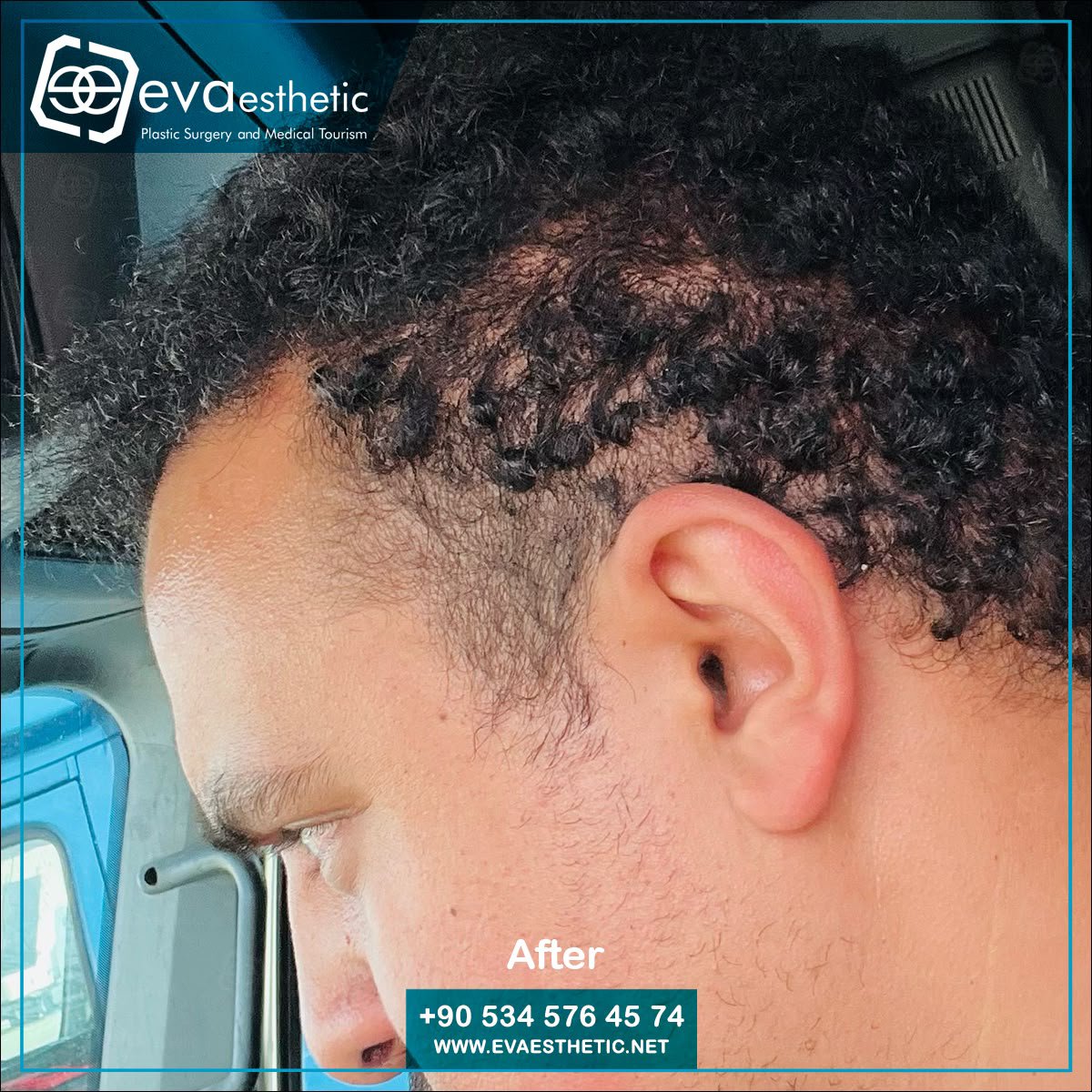 evaesthetic's tweet photo. Eva Esthetic | #Hair_Transplant ✔️.

#Hairtransplantation in #Turkey #Istanbul
Eva esthetic The #bestHairTransplant Hospital In #Istanbul 🇹🇷
#HairTransplantturkey
#plasticsurgery 
#Eyebrow_Transplant #Beard_Transplant
 🔗👇
Book now via📲:WhatsApp;📲 +905345764574
🇺🇸🇬🇧🇪🇸🇫🇷🇷🇴 https://t.co/oJNw68nbDE
