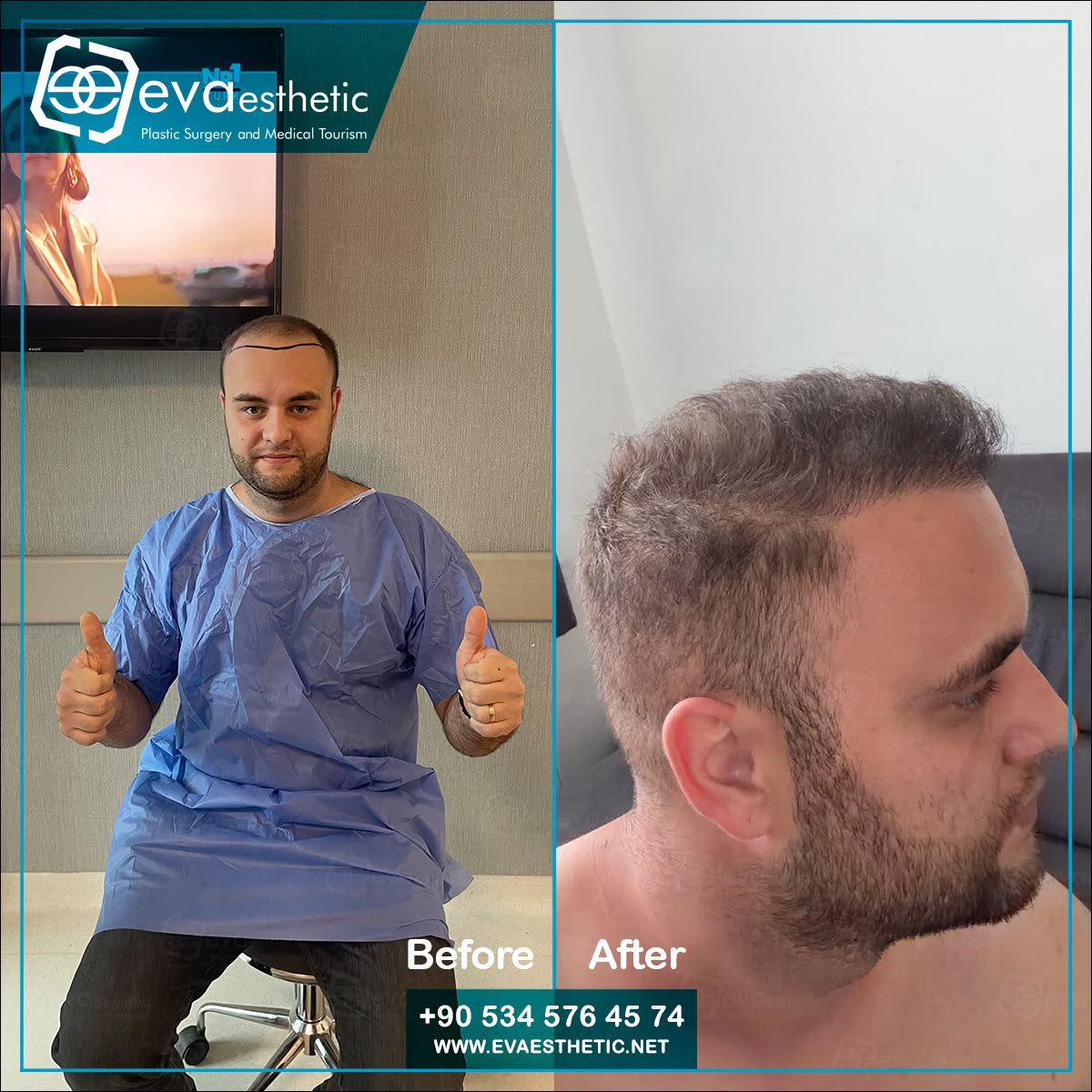 evaesthetic's tweet photo. Eva Esthetic | #Hair_Transplant ✔️.

#Hairtransplantation in #Turkey #Istanbul
Eva esthetic The #bestHairTransplant Hospital In #Istanbul 🇹🇷
#HairTransplantturkey
#plasticsurgery 
#Eyebrow_Transplant #Beard_Transplant
 🔗👇
Book now via📲:WhatsApp;📲 +905345764574
🇺🇸🇬🇧🇪🇸🇫🇷🇷🇴 https://t.co/xMzE34iDrX