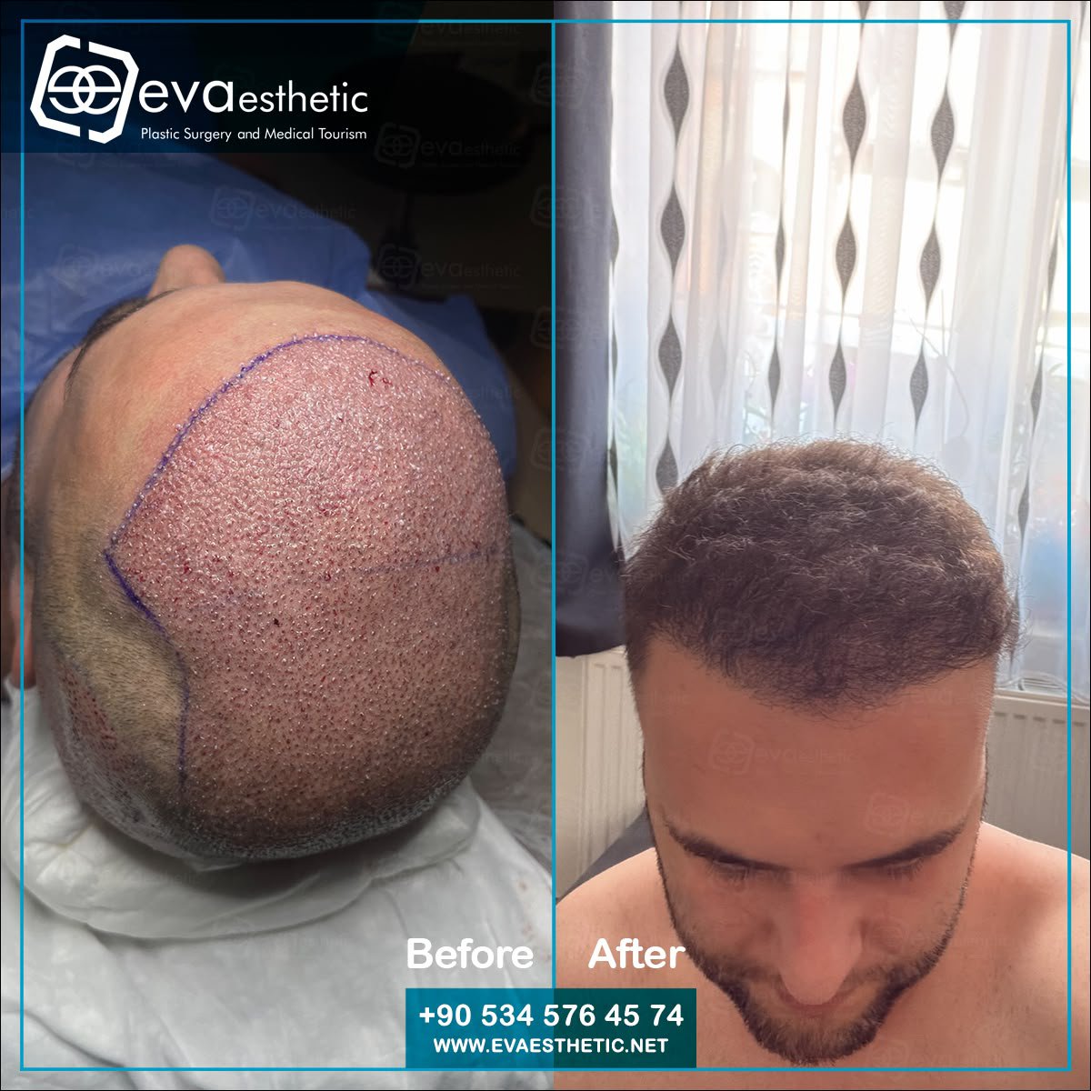 evaesthetic's tweet photo. Eva Esthetic | #Hair_Transplant ✔️.

#Hairtransplantation in #Turkey #Istanbul
Eva esthetic The #bestHairTransplant Hospital In #Istanbul 🇹🇷
#HairTransplantturkey
#plasticsurgery 
#Eyebrow_Transplant #Beard_Transplant
 🔗👇
Book now via📲:WhatsApp;📲 +905345764574
🇺🇸🇬🇧🇪🇸🇫🇷🇷🇴 https://t.co/xMzE34iDrX