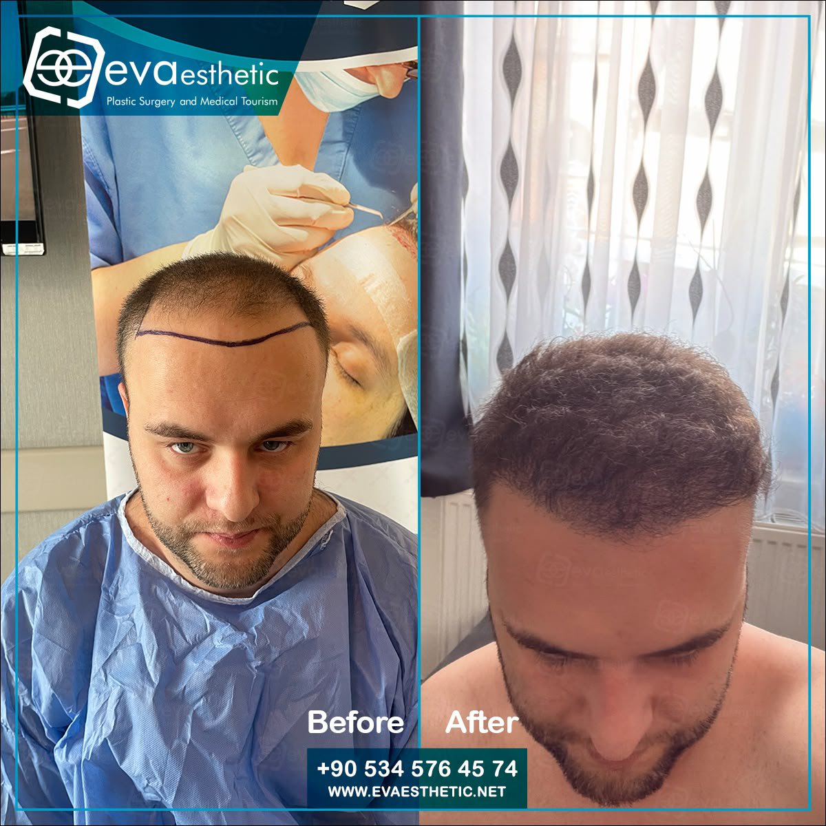 evaesthetic's tweet photo. Eva Esthetic | #Hair_Transplant ✔️.

#Hairtransplantation in #Turkey #Istanbul
Eva esthetic The #bestHairTransplant Hospital In #Istanbul 🇹🇷
#HairTransplantturkey
#plasticsurgery 
#Eyebrow_Transplant #Beard_Transplant
 🔗👇
Book now via📲:WhatsApp;📲 +905345764574
🇺🇸🇬🇧🇪🇸🇫🇷🇷🇴 https://t.co/xMzE34iDrX
