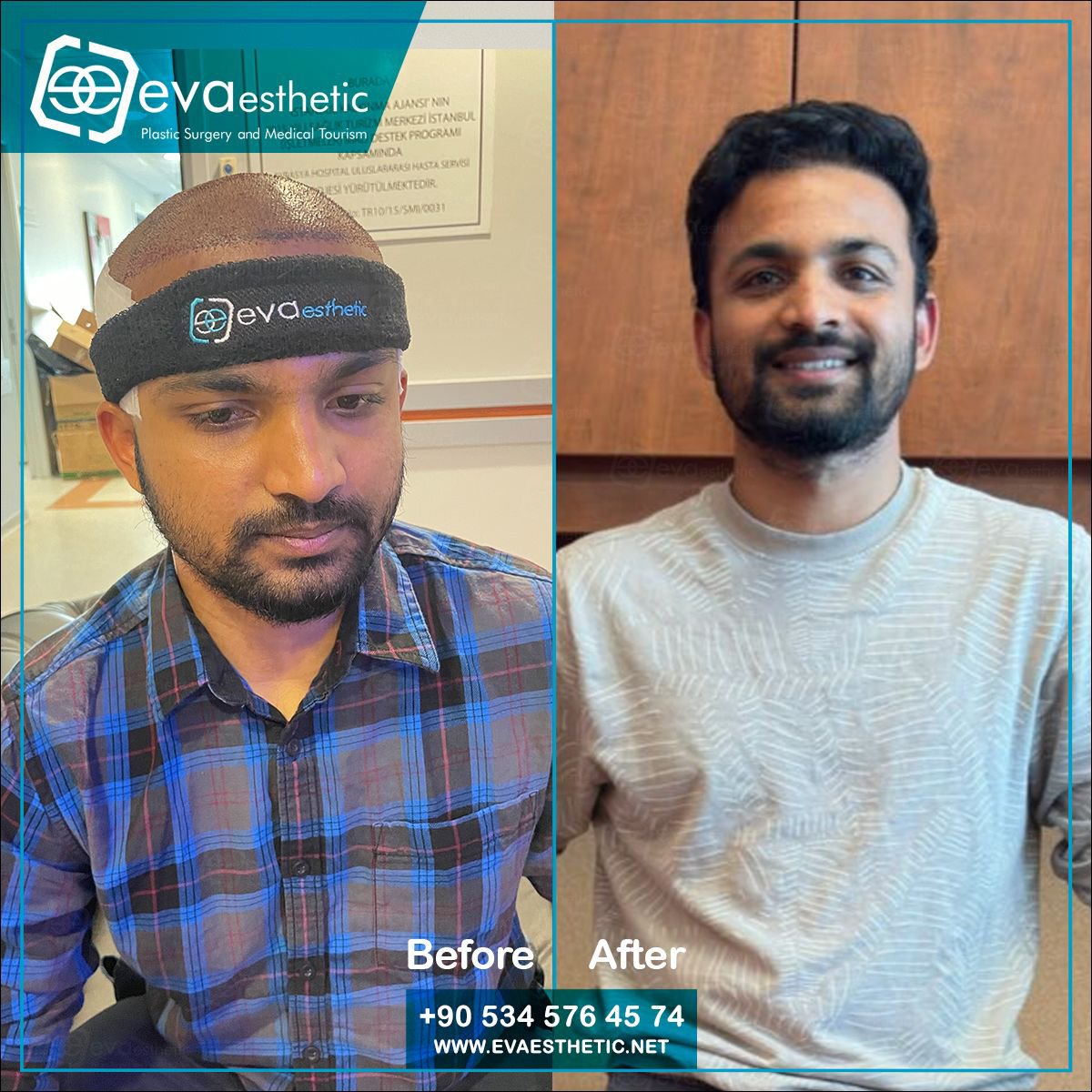 evaesthetic's tweet photo. Eva Esthetic | #Hair_Transplant ✔️.

#Hairtransplantation in #Turkey #Istanbul
Eva esthetic The #bestHairTransplant Hospital In #Istanbul 🇹🇷
#HairTransplantturkey
#plasticsurgery 
#Eyebrow_Transplant #Beard_Transplant
 🔗👇
Book now via📲:WhatsApp;📲 +905345764574
🇺🇸🇬🇧🇪🇸🇫🇷🇷🇴 https://t.co/t7W5mCYfy5