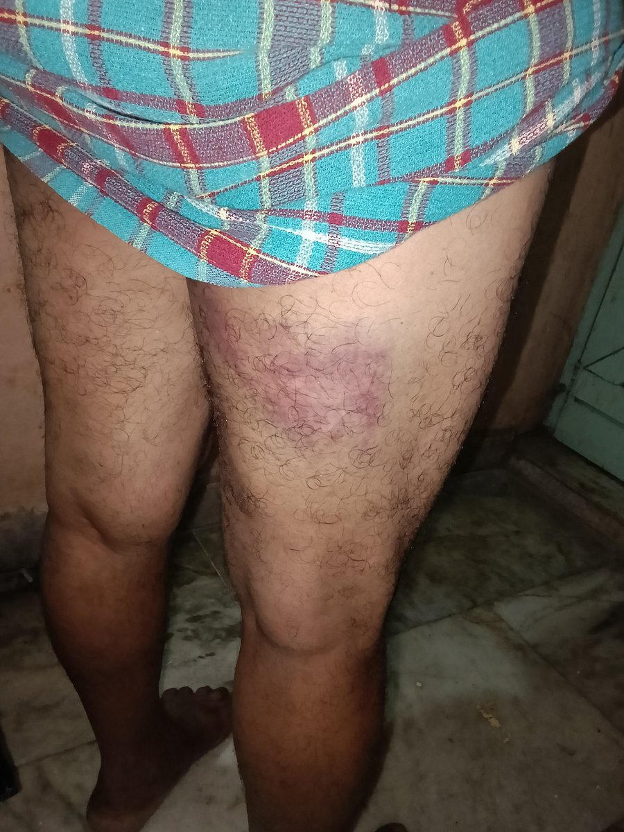 Voiceofslaves's tweet photo. @DGP_MP @MPPoliceDeptt @CMMadhyaPradesh @India_NHRC This is how Sandeep Yadav and his gang assaulted Narayan Adjuali and his family, leaving them injured. Urgent intervention needed. https://t.co/FLy1yOCX7Y