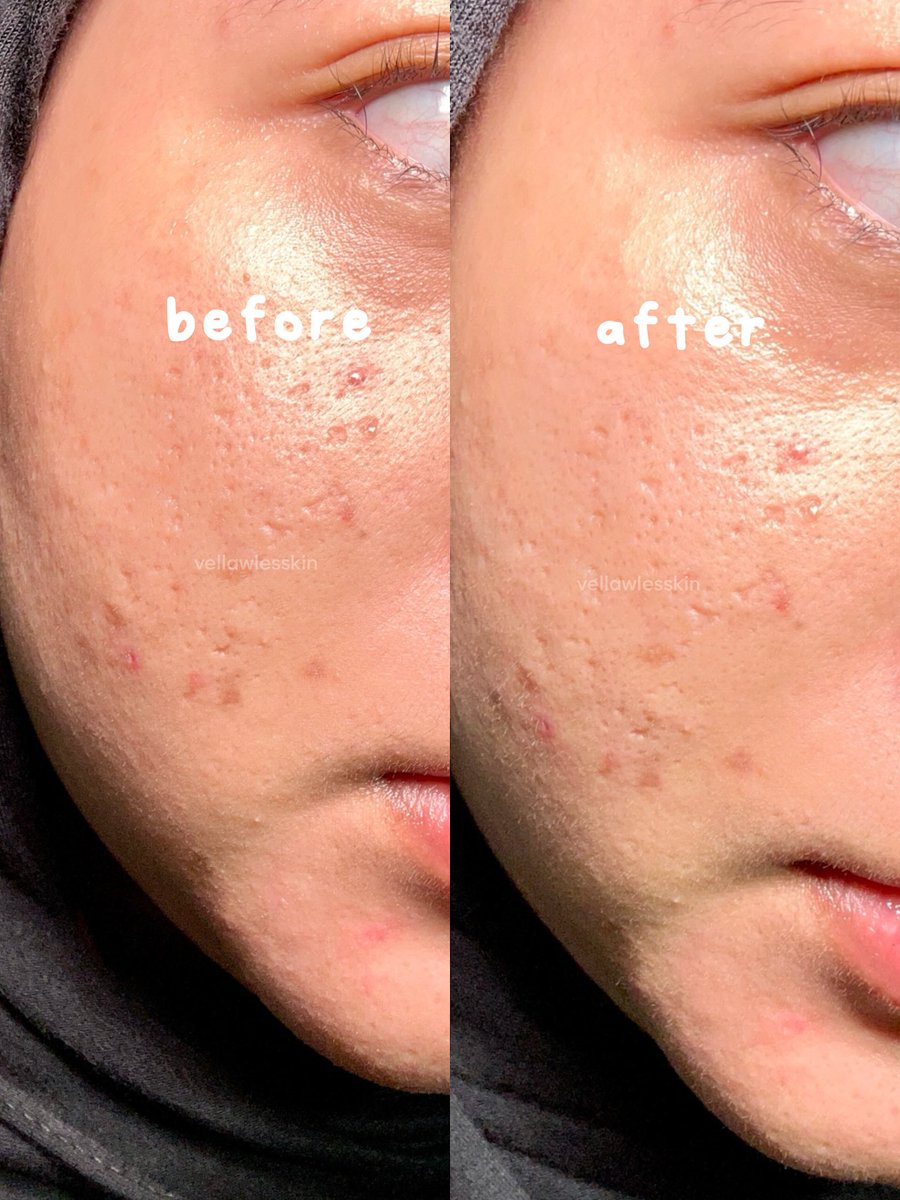 vellawlesskin's tweet photo. Emg bener kalau kulit lagi rewel balik ke skincarean basic aja.
Modal ga ada 100k jerawat kemerahan langsung CALMINGG! https://t.co/xW1dBxF1dT