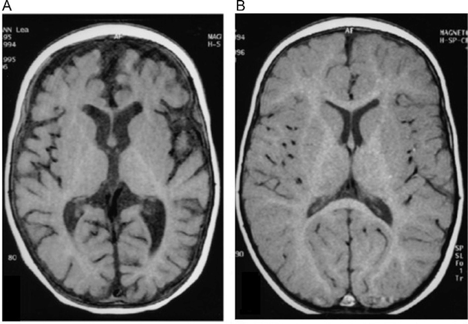 Ivermectinkart's tweet photo. Brain atrophy in a baby with vitamin B12 deficiency and its reversal by B12 treatment.

6 month old girl was "born into a family of vegetarians whose intake of milk and dairy products had been minimal." https://t.co/jL3ZyMhHHU