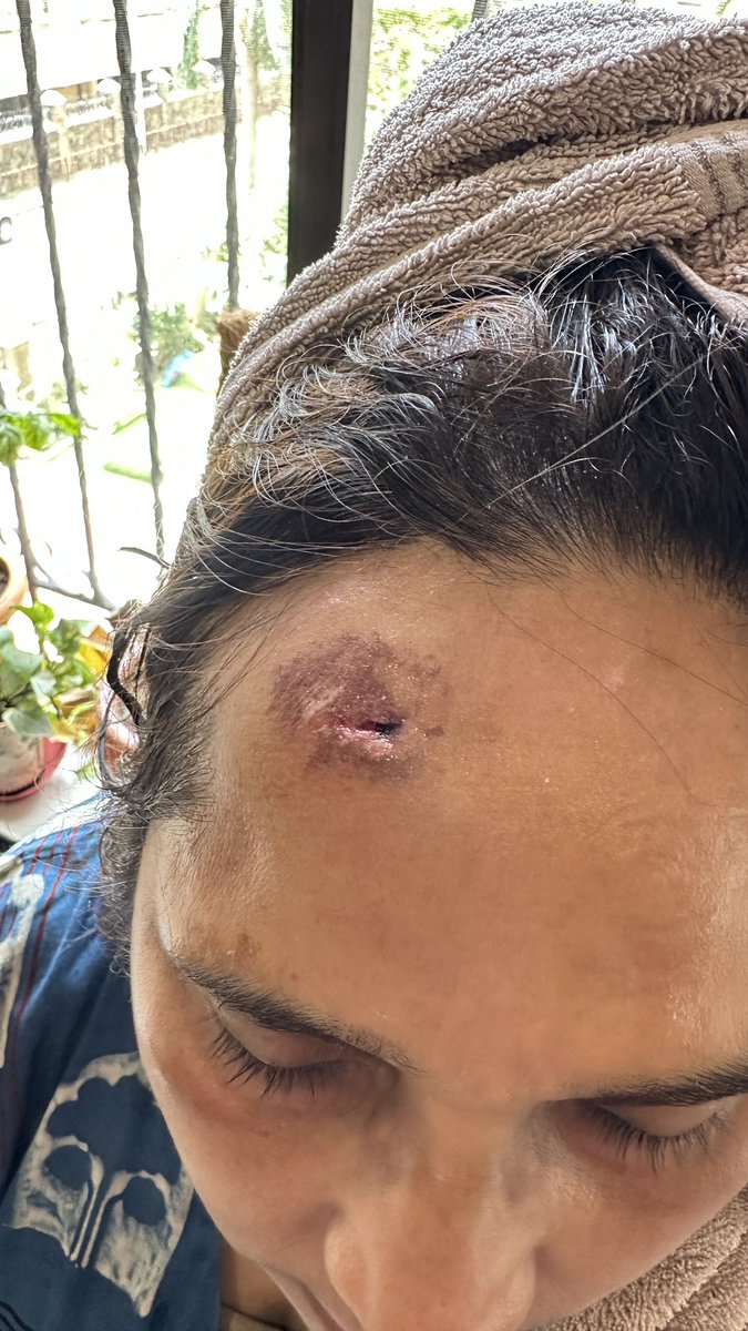 skiy7's tweet photo. Special thanks to the driver who removed his first aid kit and gave treatment to my wife yesterday after the pavement accident. 
And a thumbs down to the security staff of @Lotusdevelopers who just were mute spectators! 
They refused to even allow me to record where the accident took place ! 
Stay safe people this can happen to your loved one also . Thanks to our excellent pavements maintained by our taxes . 
A shoutout of thanks to emergency department of @KDAHMumbai who did the shoulder relocation very skill fully @AndheriLOCA @RoadsOfMumbai @MissdOportunity @AhujaJiten