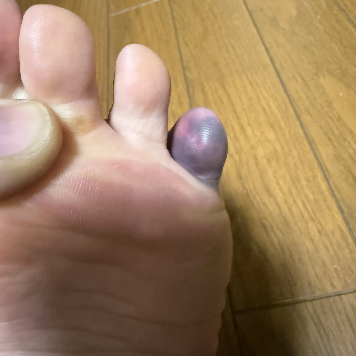 MAR18SDT's tweet photo. 痛いよー😣 https://t.co/Zg2nmrhLPT