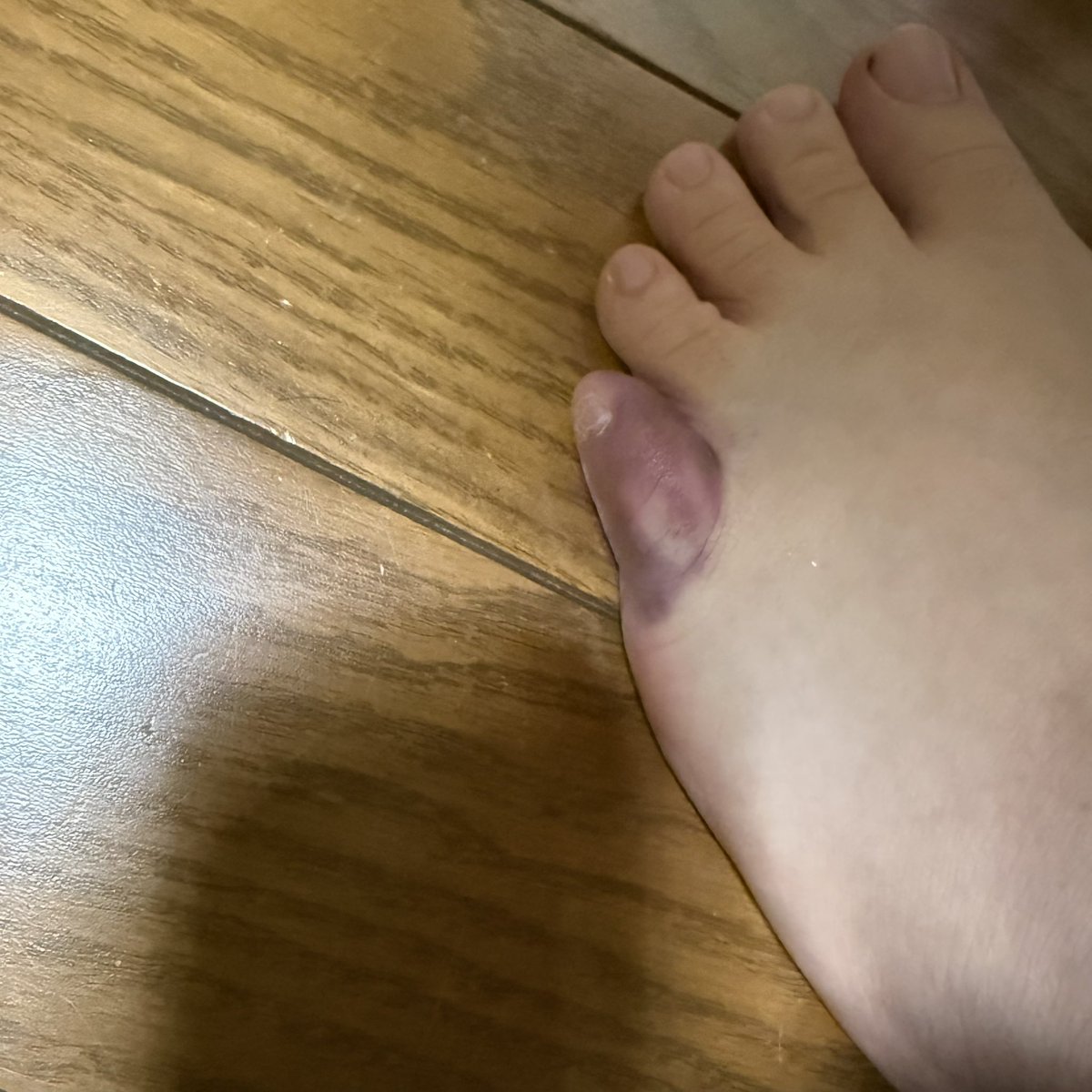 MAR18SDT's tweet photo. 痛いよー😣 https://t.co/Zg2nmrhLPT