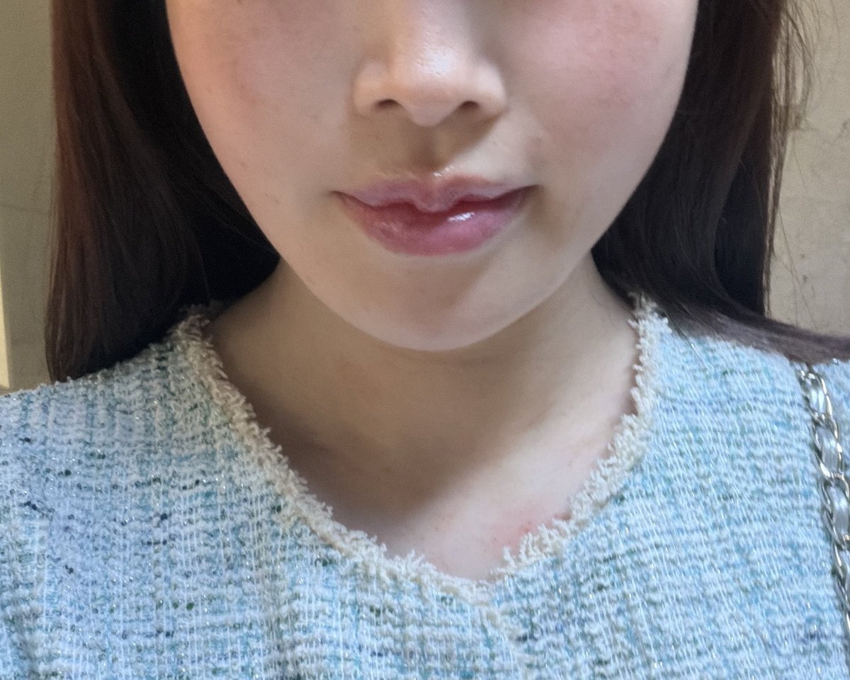 e0qtp's tweet photo. 今後ハイフされる方の参考がてらに。
今回の施術直後すぐに撮った写真ですが、施術直後は大きな赤みや腫れもなくめちゃくちゃ綺麗だったんですが、照射痕と赤みと腫れがでてきたのは約1〜2時間後でした💦
首はただ痒くて掻いた跡です🤣 https://t.co/zzvoipWhby