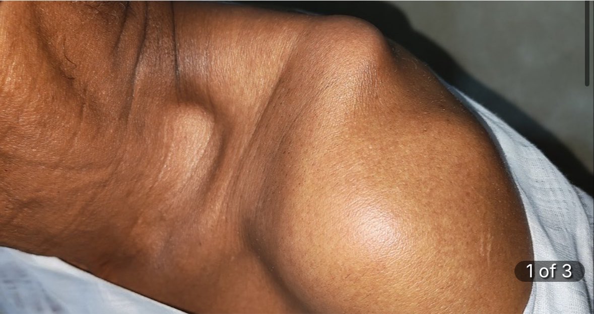 SimsimAlbadri's tweet photo. Adam is a Sudanese refugee living with a painful broken clavicle.
The goal is within reach let’s get him the surgery he desperately needs‼️ https://t.co/QRoXUOs4aM