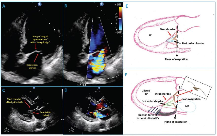 Ahmedata7777's tweet photo. The Seagull Sign of Anterior Mitral Leaflet

🩺 What is the Seagull Sign?

In echo, the mitral valve seagull sign refers to a distinctive wing-like distortion or "kink" in the middle of the anterior mitral valve leaflet during systole, mimicking the wings of a flying seagull. https://t.co/i25B4Wn8bL