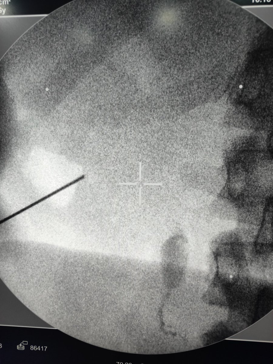 Eslam_wareth's tweet photo. Impacted stone upper ureter 
When there is no way to reach it from the ureter 
It's time to do a direct puncture and opacifaying the system then redo a good scientific puncture  
#urology 
#endourology 
#tips_tricks 
#stones https://t.co/ozuv8JtcrH
