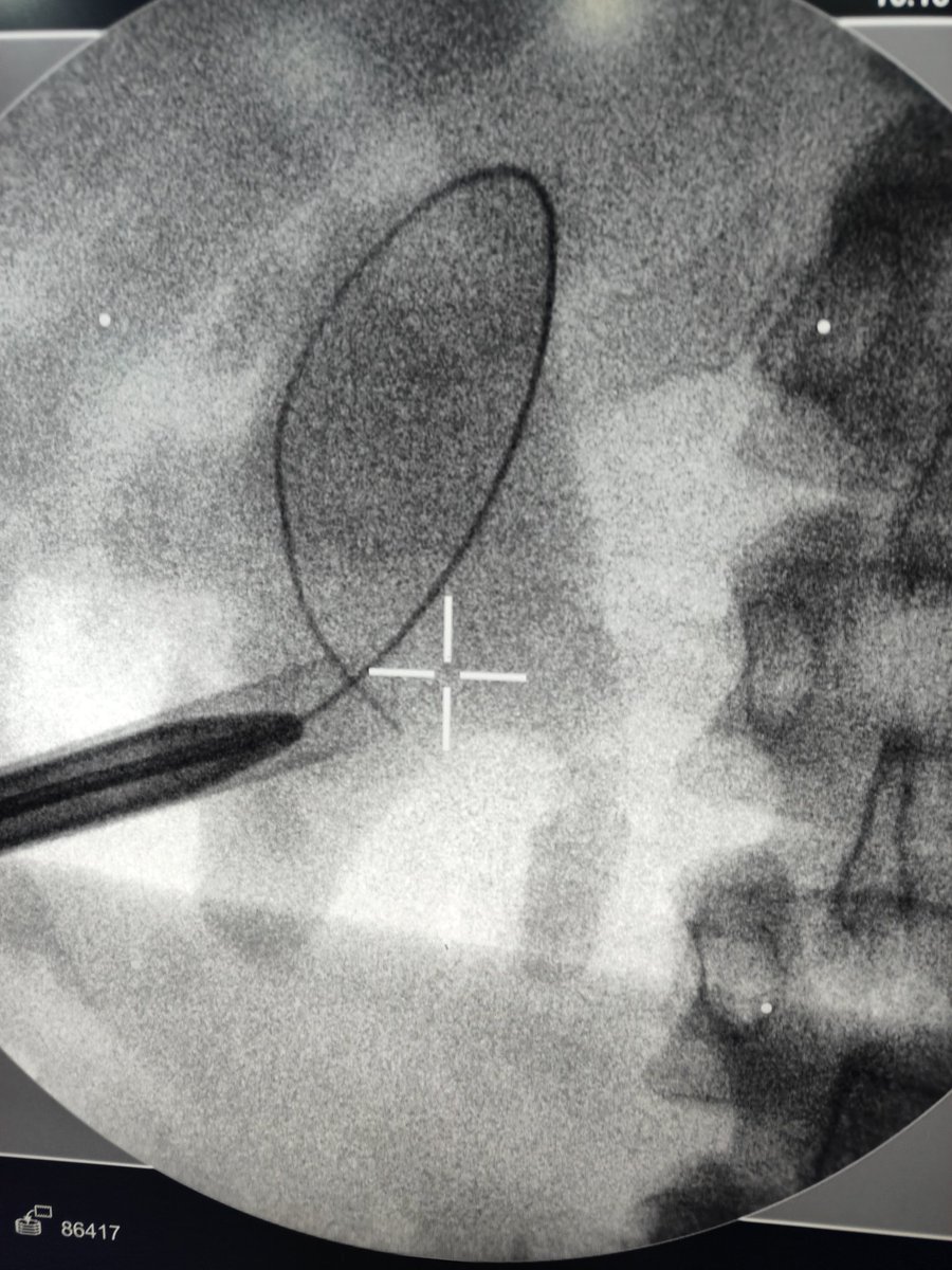 Eslam_wareth's tweet photo. Impacted stone upper ureter 
When there is no way to reach it from the ureter 
It's time to do a direct puncture and opacifaying the system then redo a good scientific puncture  
#urology 
#endourology 
#tips_tricks 
#stones https://t.co/ozuv8JtcrH