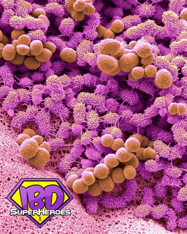 IBDSuperHeroes's tweet photo. 🔬 Learn more about @BowelResearch https://t.co/QGvKwjXYWX and consider raising funds with #IBDSuperHeroes for vital research to save and improve lives for people with #Crohns and #Colitis: https://t.co/vsH6efgyZe

#IBD #CrohnsDisease #UlcerativeColitis #IBDawareness #CutTheCrap https://t.co/qFr5NRM41A