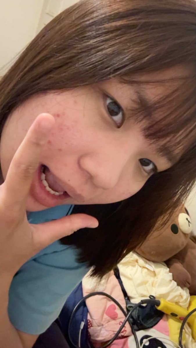 Reeed19997's tweet photo. 有人會介意女生臉上有幾顆痘痘嗎？ https://t.co/q7g17LxSLF