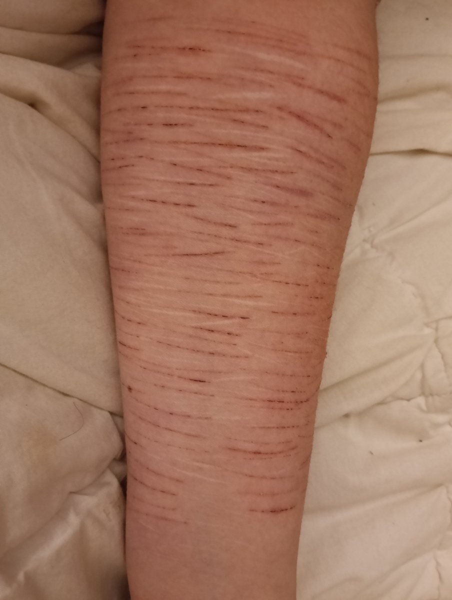 k1ttygrl_pompom's tweet photo. Guess which arm is my favorite level impossible!!! #shtwt #catscratches #sfx #sfxmakeup #fake #nonofthisisrealokaytwt #itsmakeup https://t.co/NNwRBBbznc