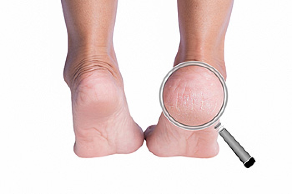 gkperelmandpm's tweet photo. How a Podiatrist Treats Cracked Heels https://t.co/U8BFKehUaJ https://t.co/UuEtWCu1tW