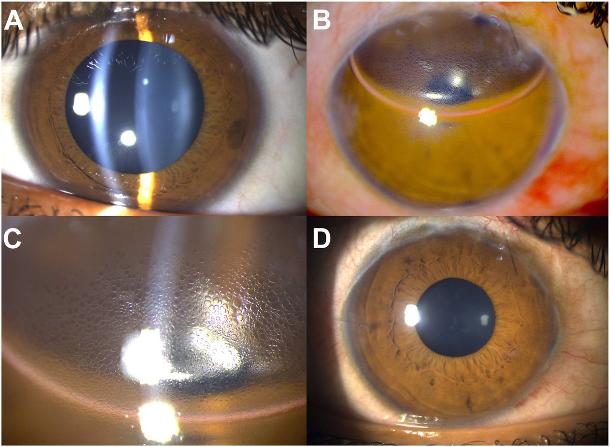AAOjournal's tweet photo. A 21-year-old man with juvenile open-angle glaucoma (A) underwent gonioscopy-assisted transluminal trabeculotomy. Intracameral air was injected at the end of surgery to pressurize the globe and prevent reflux bleed. The next day, focal corneal epithelial bullae appeared in the region over the partially resorbed air bubble (B, C). The bullae resolved by day 5 with air resorption (D), and visual acuity recovered to 6/6. While intracameral air is known to affect the endothelium, this case suggests it can also cause localized, transient epithelial microcysts at the air–cornea interface, and warrants caution in eyes with a potentially compromised endothelium.
https://t.co/x4Zep79ELI
@manchanda1995
#ophthalmology #glaucoma