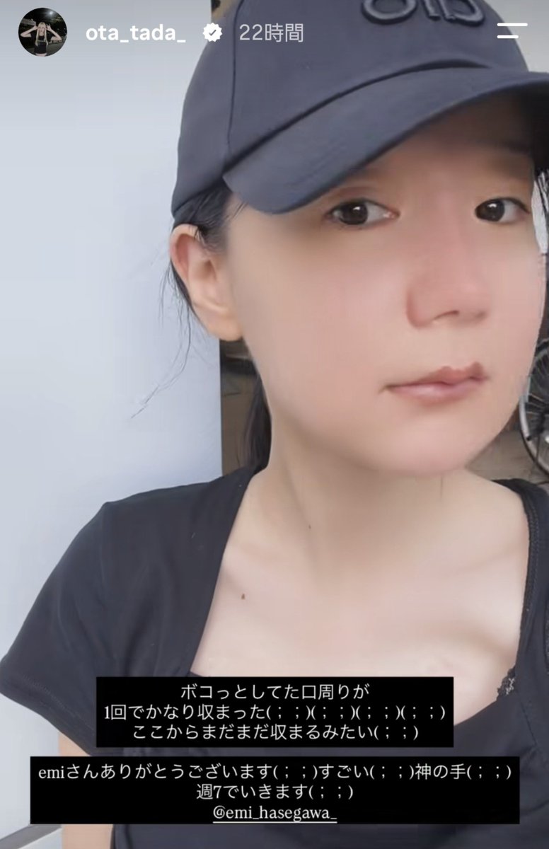 nyunnyun05's tweet photo. フェフ姉さんのお友達の多田さんが
両顎のダウンタイム中の具体的な様子やインディバのBefore/Afterまで
めちゃめちゃ具体的に教えて発信くれてて情報量が有料級すぎてまじでありがたい… https://t.co/8cwdGbCMPZ