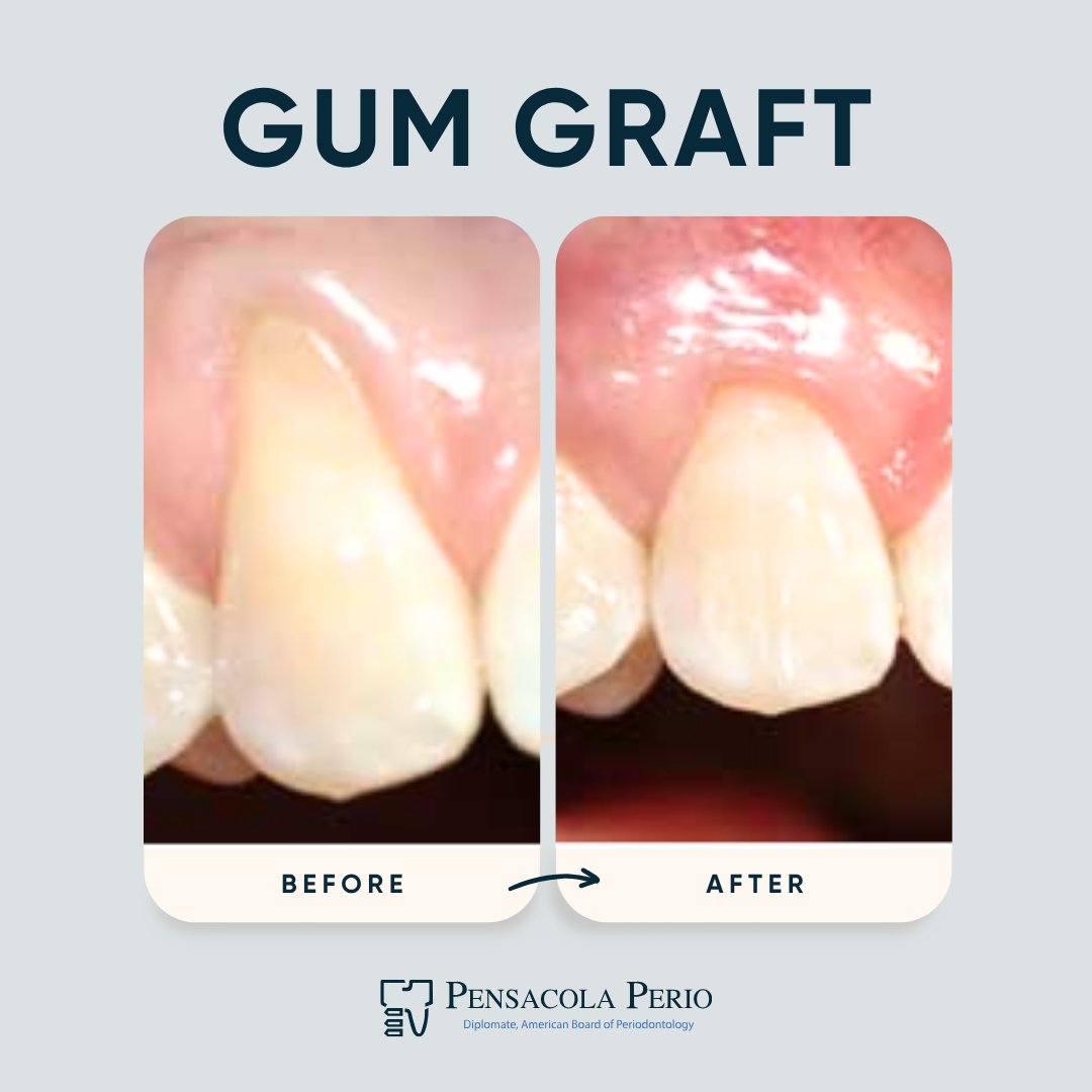 DavidRWilliam20's tweet photo. Gum grafting can restore a healthier gumline, reduce sensitivity, &amp; protect exposed tooth roots. These results show periodontal treatment can support both function &amp; appearance.

New Patients:
(850) 752-5230

Current Patients:
(850) 433-1543

#Periodontist #DentalImplant #Smile https://t.co/IppeMJqE6r