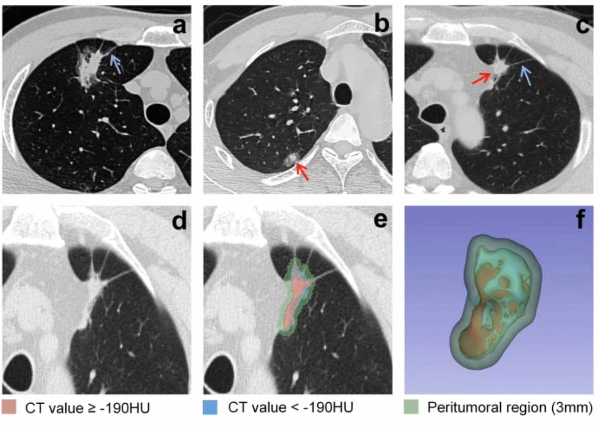 Dx_imaging's tweet photo. Can #AI Enabled Intratumoral CT Threshold Segmentation Help Predict Visceral Pleural Invasion in #LungCancer Patients?
https://t.co/nwcBIb24E6
@RadiologyACR @ARRS_Radiology @RSNA @thoracicrad
#radiology #RadRes #CTRad https://t.co/jrs5YuCWL9