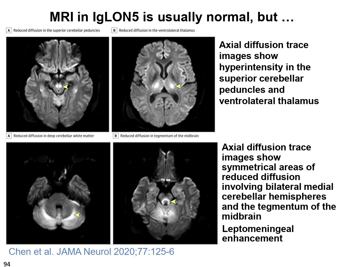 MichaelOkun's tweet photo. One of the messages from Joe Jankovic's outstanding Aspen Movement Course lecture today on autoimmune-associated movement disorders that stuck with me was the importance of resisting the temptation to over-diagnose rare conditions. With the growing awareness of anti-IgLON5 disease, many of us have probably been ordering the antibody test more often than we should. Joe reminded us that testing is most appropriate when the clinical picture includes the characteristic sleep disorder, which remains one of the strongest clues to the diagnosis. He also shared an important case where the MRI showed abnormalities, underscoring that imaging can occasionally be helpful, although MRI is normal in most patients with IgLON5 disease. Perhaps he and Alberto Espay's most practical pearl was one we should all remember in clinic: if a patient looks like they have classic progressive supranuclear palsy (PSP), they probably have classic PSP, not IgLON5 disease. As new biomarkers emerge, thoughtful clinical judgment remains our most valuable diagnostic tool.