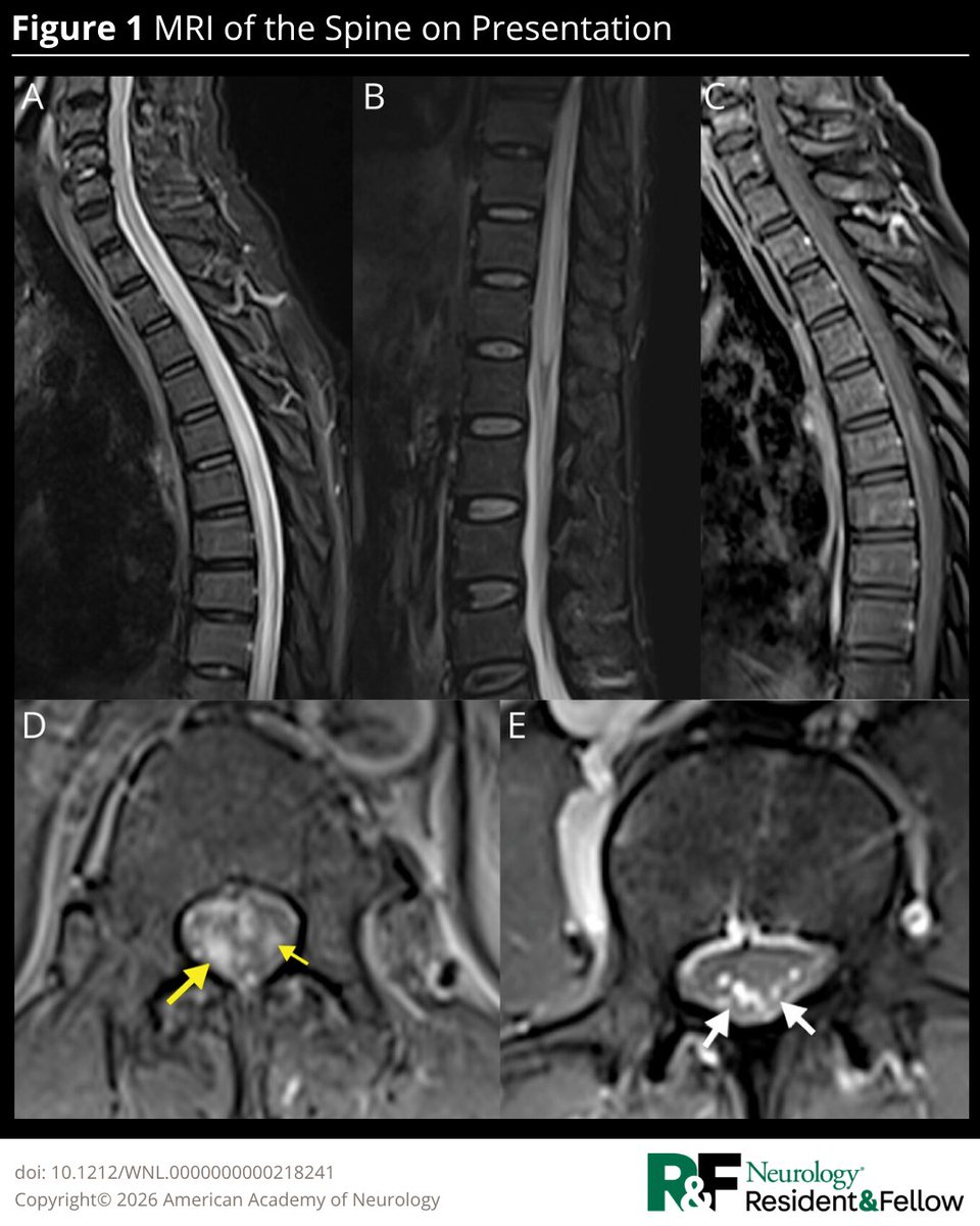 GreenJournal's tweet photo. A 54-year-old farmer presented with a 5-day history of progressively worsening right leg weakness, truncal dysesthesia, and 1 day of painless urinary retention, without systemic symptoms. Read the full Teaching #NeuroImage case: https://t.co/pXsvEaTpSd

#NeurologyRF https://t.co/oFHdDG06IP