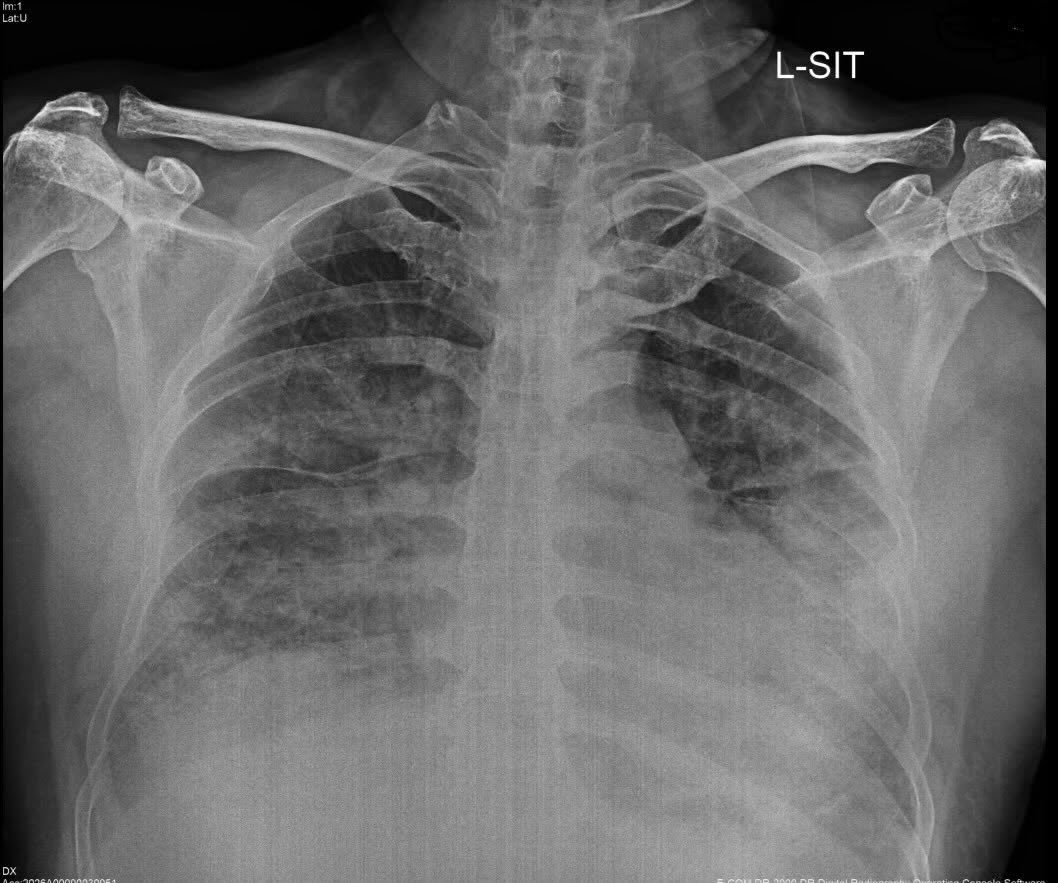 HiraaliCardio's tweet photo. Male, 56 years old.
Severe SOBs, screaming/crying out, chest pain  cold sweats , DM +ve, post-PCI (02/26) , Rhonchi, pitting edema.
BP: 110/80, SpO2: 75%, Hb: 13, Leukocytes: 19,000, Platelets: 307,000, Blood glucose: 552, Troponin I: 44 https://t.co/Q6pSaVEYLj