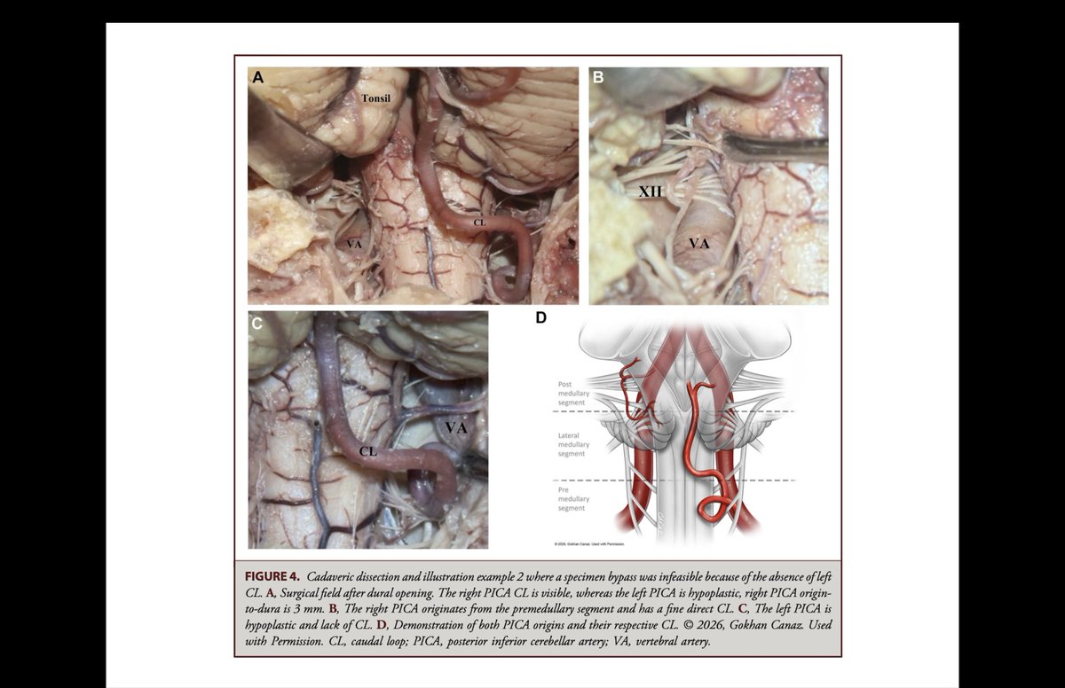 drufukerginoglu's tweet photo. 🧠 The best bypass is the one the patient's anatomy allows.
Our anatomical study defines the key determinants of PICA-PICA bypass feasibility.
🔗 https://t.co/HPsPC7hyno
#Neurosurgery #Microsurgery https://t.co/31n6vK9GvX