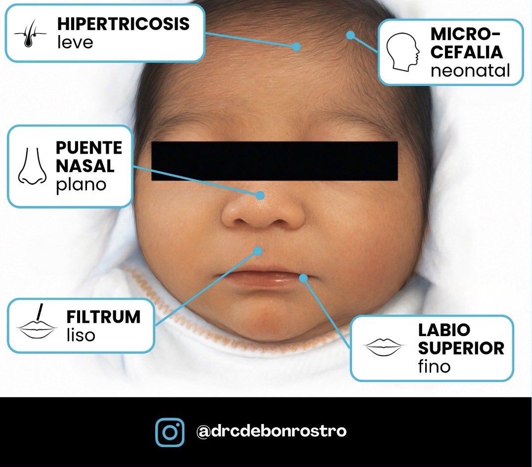 drcdebonrostro's tweet photo. ⚠️ Neonato con PUENTE NASAL PLANO, FILTRUM LISO, BORDE BERMELLÓN DE LABIO SUPERIOR FINO Y MICROCEFALIA.

¿Cuál puede ser la sospecha? 🤔

👉🏼 Hoy hablamos de un síndrome congénito, completamente evitable, pero que por desgracia todavía vemos a día de hoy.

Dentro #Hilo 🧵👇🏼 https://t.co/GrS829fma6