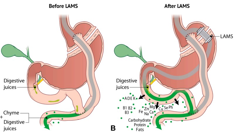 GIE_Journal's tweet photo. Listen to the podcast of "Lumen-apposing metal stents for partial reversal of Roux-en-Y gastric bypass: a multicenter study" by Kadkhodayan et al. https://t.co/17kFtvX4Jd 

#GITwitter 

@KKadkhodayan https://t.co/aG6dfDYJQ7