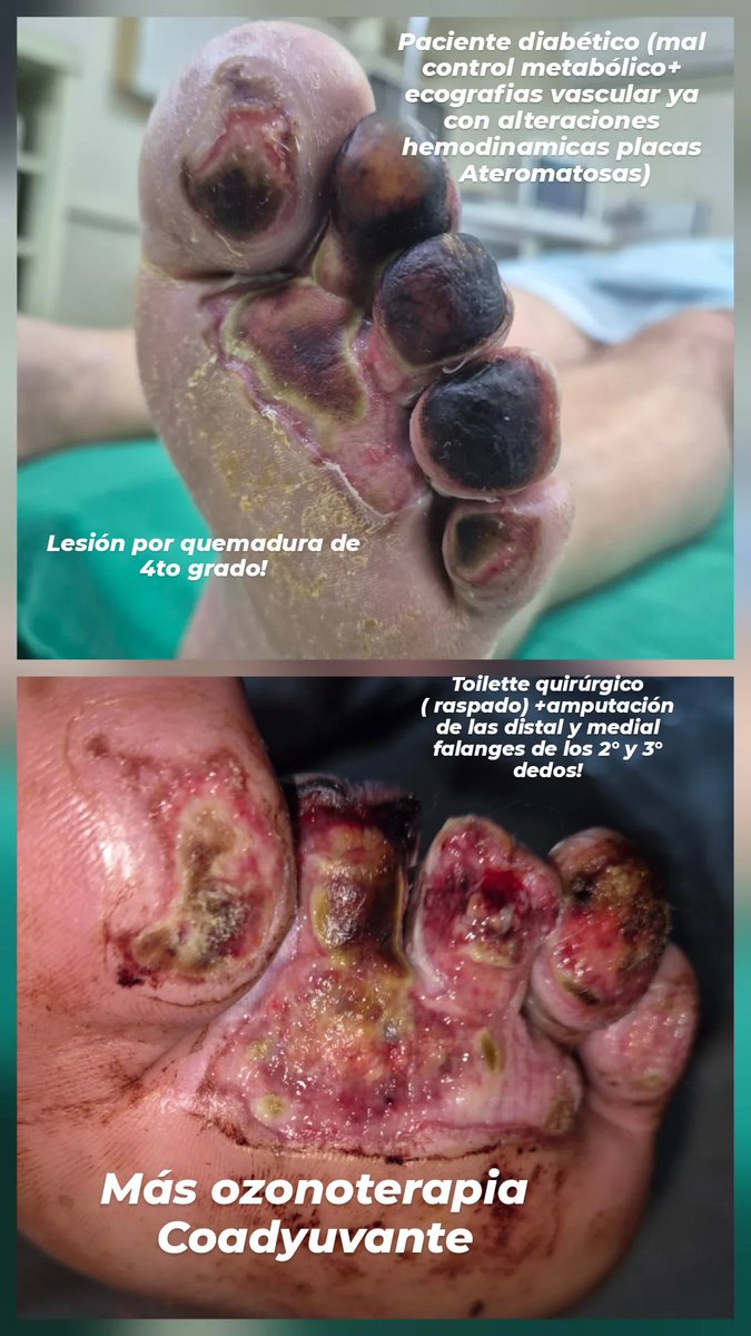 MolasFlorentin's tweet photo. #DRMOLASCIRUGIAVASCULAR_FLEBOLOGIA 
#Pie_Diabético_Molas_Py https://t.co/UTZZSMgFim