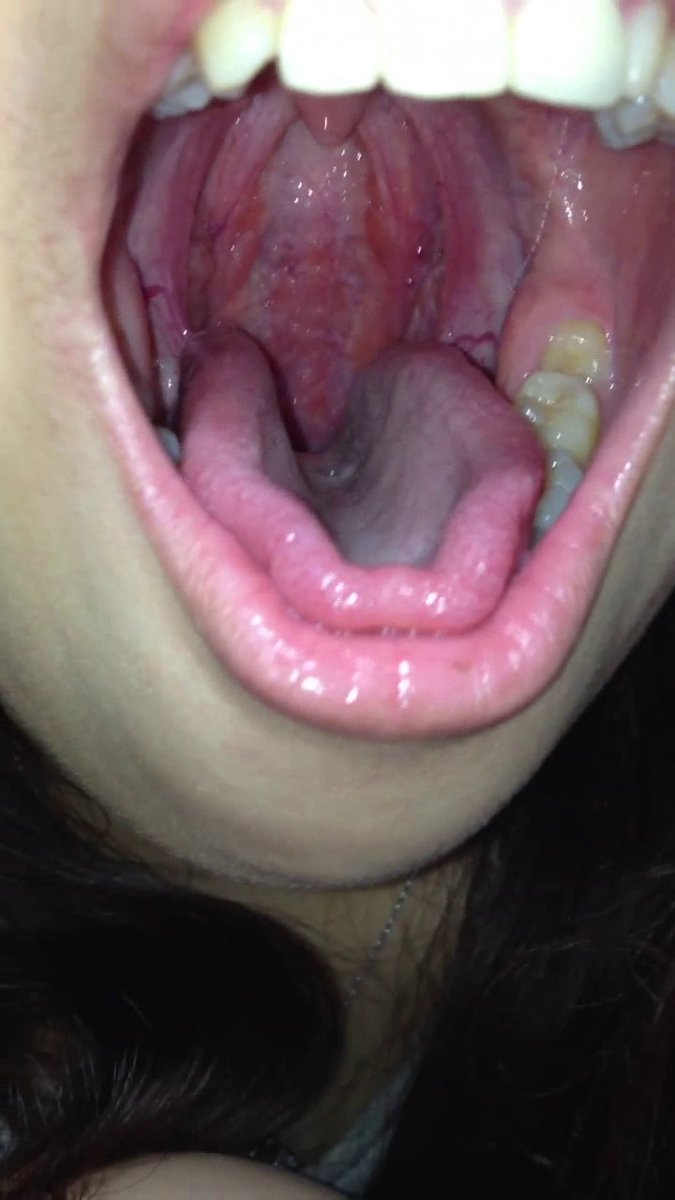 honmuster's tweet photo. 笑った時にのどちんこが見えるということは、彼女の喉の開口部が非常に大きい可能性が高いことを示す良い指標です。 https://t.co/bElplKQ9Hm