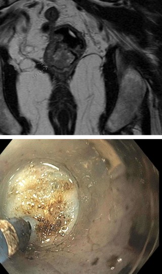 GIE_Journal's tweet photo. Online now in GIE’s Articles in Press: "Performance of magnetic resonance imaging in the staging of rectal polyps undergoing endoscopic resection: a U.S. academic cancer center experience" by Phillip S. Ge et al. https://t.co/IM6gigkMcT

#GITwitter https://t.co/EDSC8JJn5y