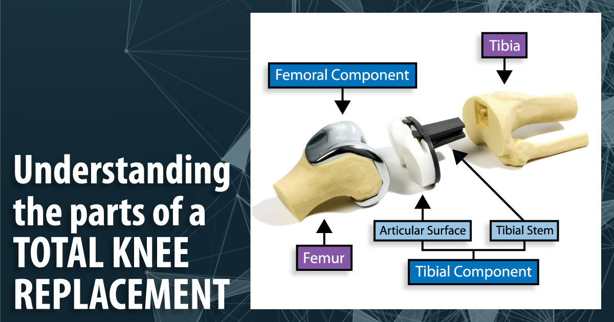 Arthritisports's tweet photo. A total knee replacement does not replace the entire knee. Damaged joint surfaces are covered with specialized metal and plastic components designed to restore smoother movement.

It may be considered when advanced arthritis causes persistent pain and limited mobility. https://t.co/ot2YseHlsN