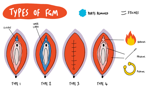 Ri95Tae's tweet photo. @ombuty @delah_creme @_mpekethu_ "Global estimates show that the vast majority of female genital mutilation (FGM) cases consist of Type 1 and Type 2 (80% to 85% combined), while Type 3 accounts for about 15% of cases."

clit removal fgm is the most common. 
not the clitoris cover, the clitoris https://t.co/mTcouSHM3m