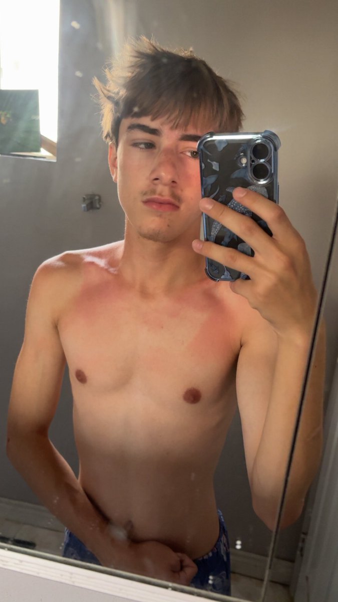porcelalina's tweet photo. sunburnt again https://t.co/7aLQUG0u51