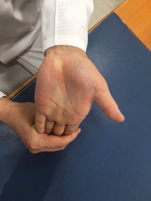 tutiyak's tweet photo. 熊本、九州の余震も心配です。

不安で胸のざわつきに「労宮（ろうきゅう）」のツボ

こぶしを軽く握ったとき、中指と薬指の先が当たるところです。ゆっくり押すだけでも、ドキドキや不安がふっと和らぎます。

手のひらを開いたり、外側にそらすストレッチを加えるのもおすすめです。 https://t.co/sknR1JiW0S