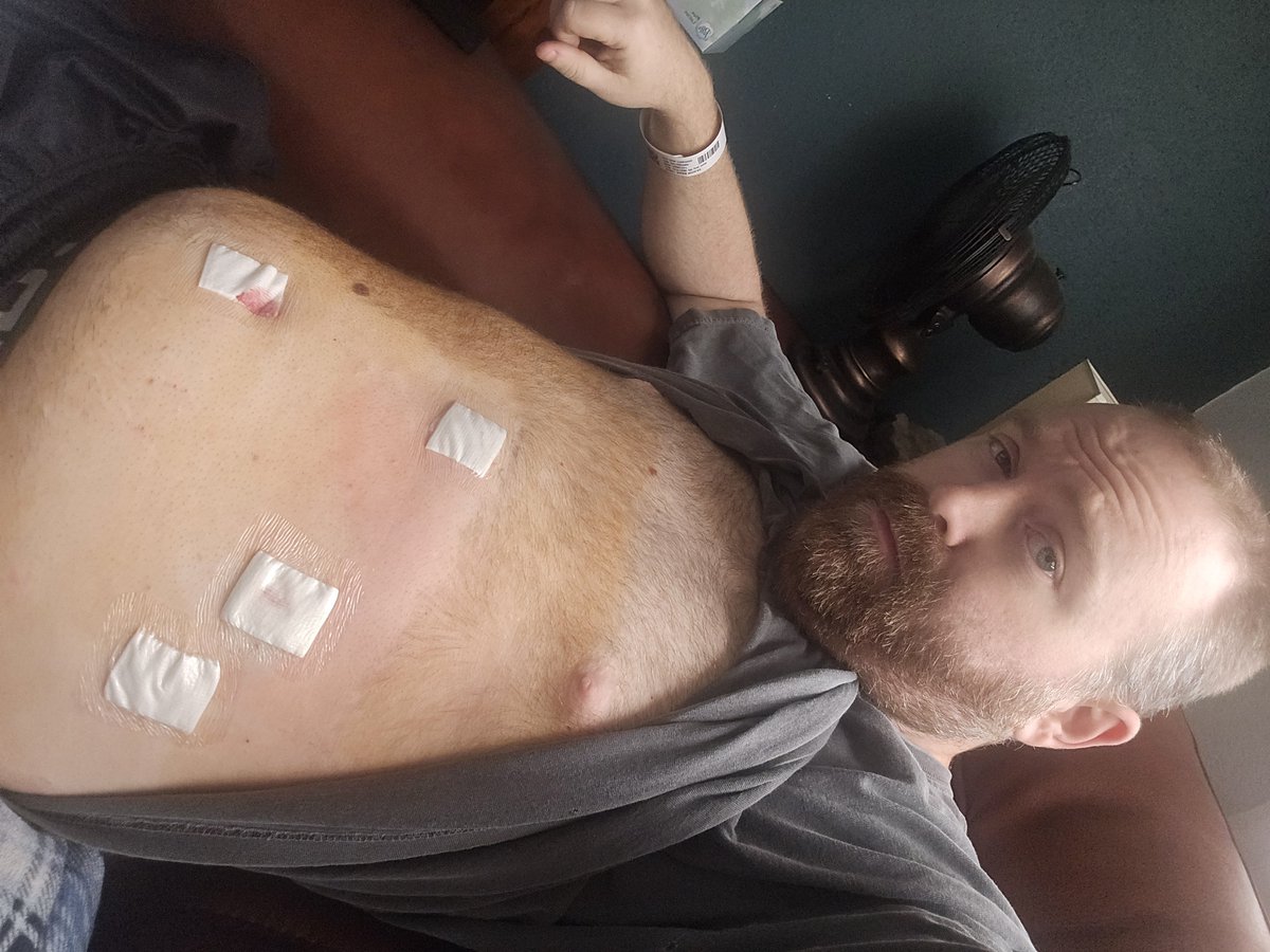 BoozeShep's tweet photo. Gallbladder removal went well. Im home, sore and ready for bed https://t.co/IjKoZNtvzm