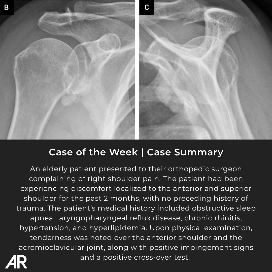 Applied_Rad's tweet photo. π©» Case Study of the Week!
An elderly patient presented to their orthopedic surgeon complaining of right shoulder pain.
π See all the case details, more images, and diagnosis: https://t.co/u4AqgJg9u9
#Radiology #RadEd #MedEd #RadiologyEducation #COW #CaseOfTheWeek https://t.co/VukpAZOPv1